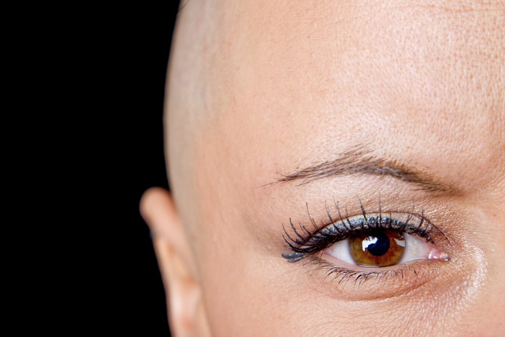 A bald woman who is a cancer survivor