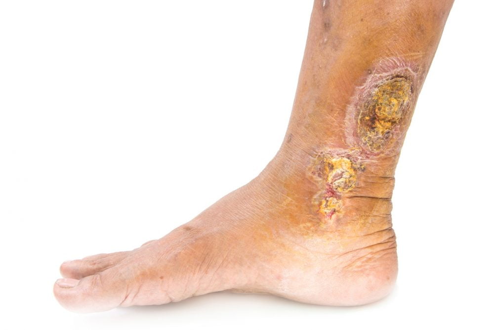 venous leg ulcers