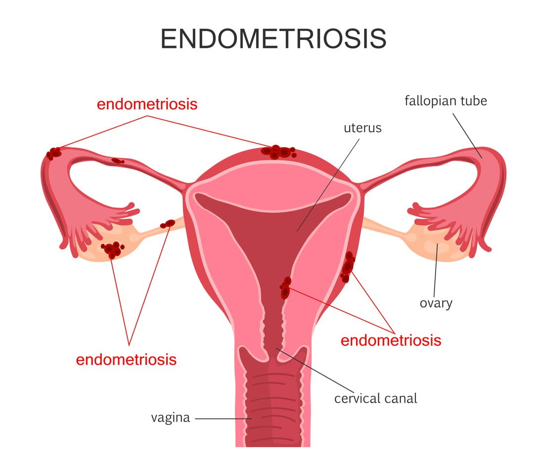 latest research for endometriosis