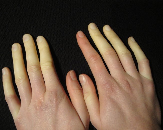 Raynaud's Phenomenon - discoloured fingers
